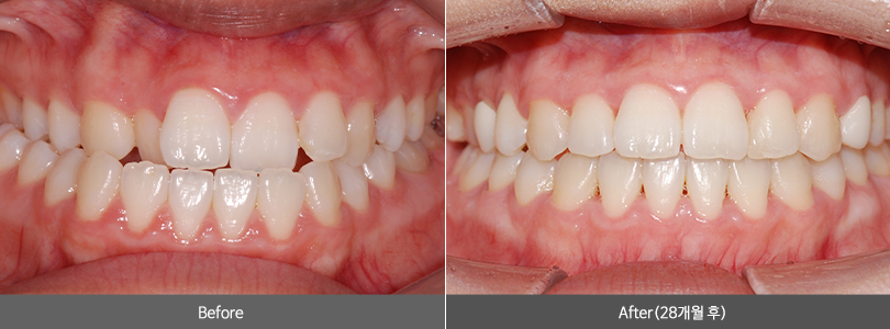 치아 정면교정 전후사진