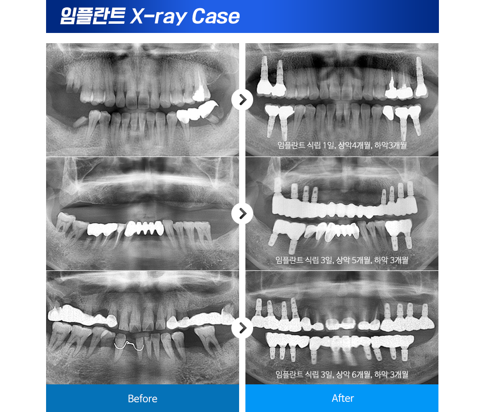 X-ray 임플란트 전후사진